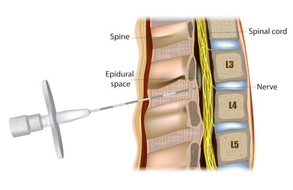 Can A Spinal Block Cause Nerve Damage